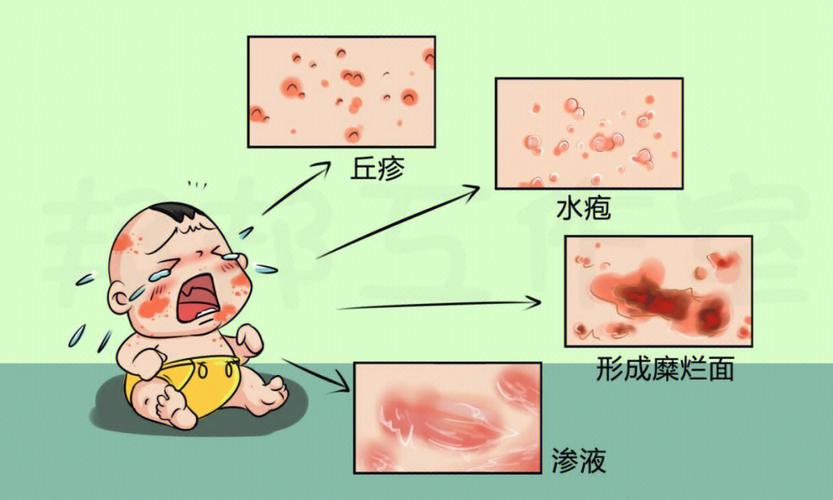 供卵代孕宝宝的湿疹是什么原因